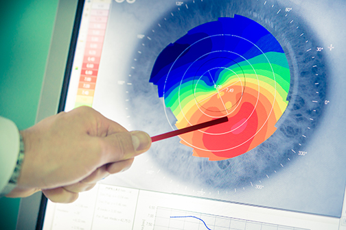 corneal topography